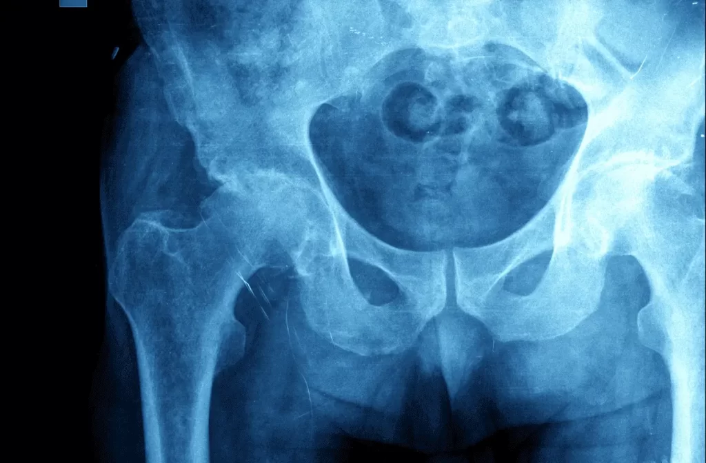 Individuals who are 75 years old and above are highly susceptible to hip fractures