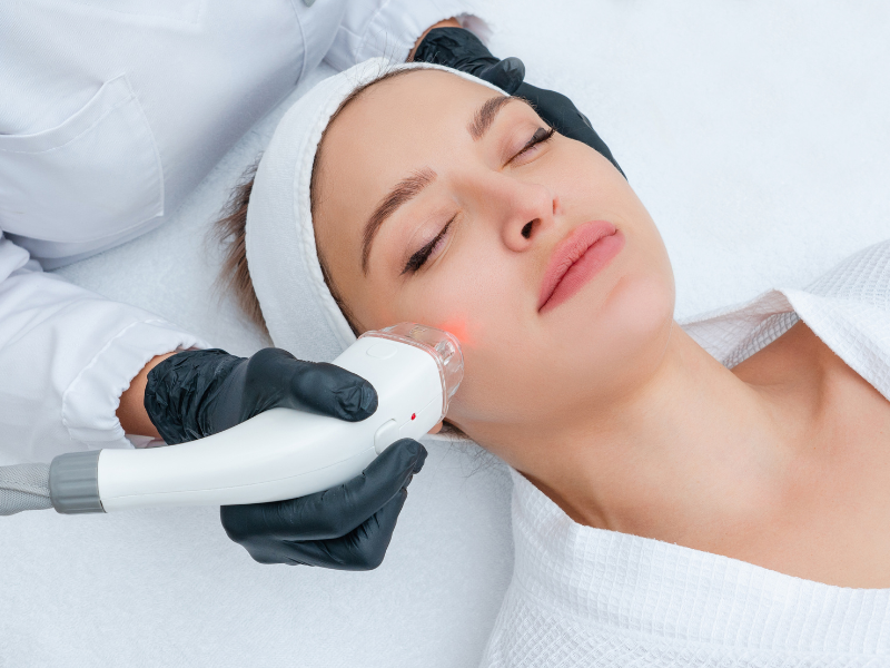 Woman receiving laser skin treatment for acne scar reduction