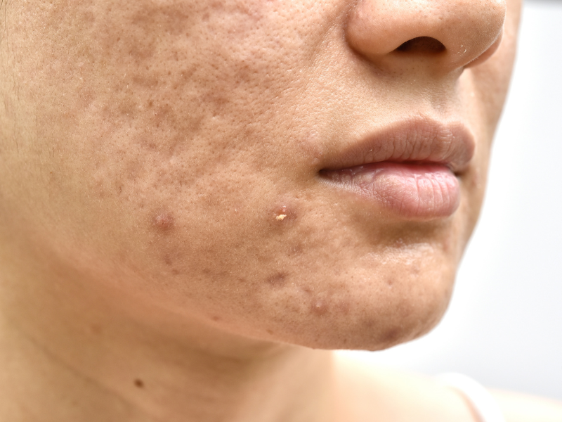 Woman's lower face showing deep acne scars and breakouts