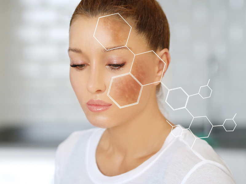 Woman with pigmentation spots highlighted by digital overlay on face