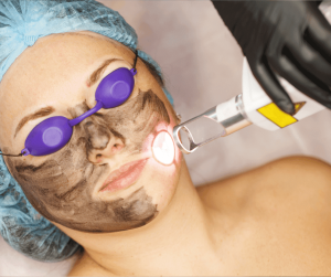 Carbon Laser for Pigmentation