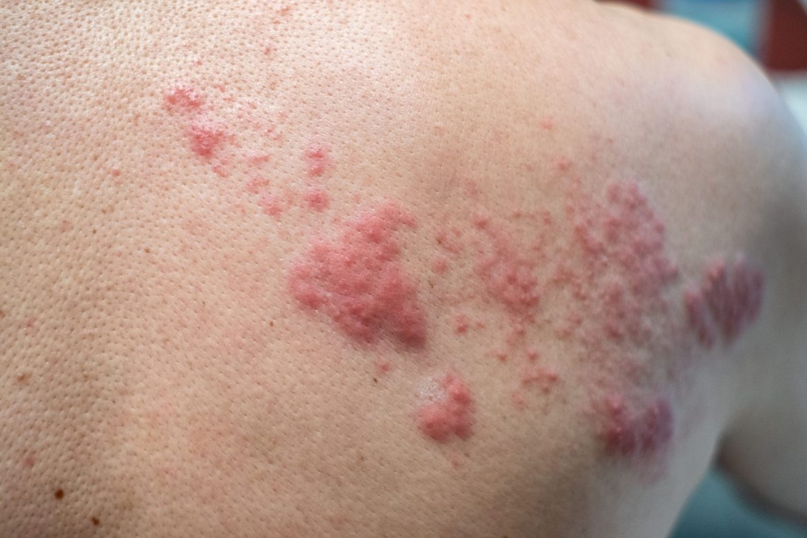 patient with shingles rashes on the back