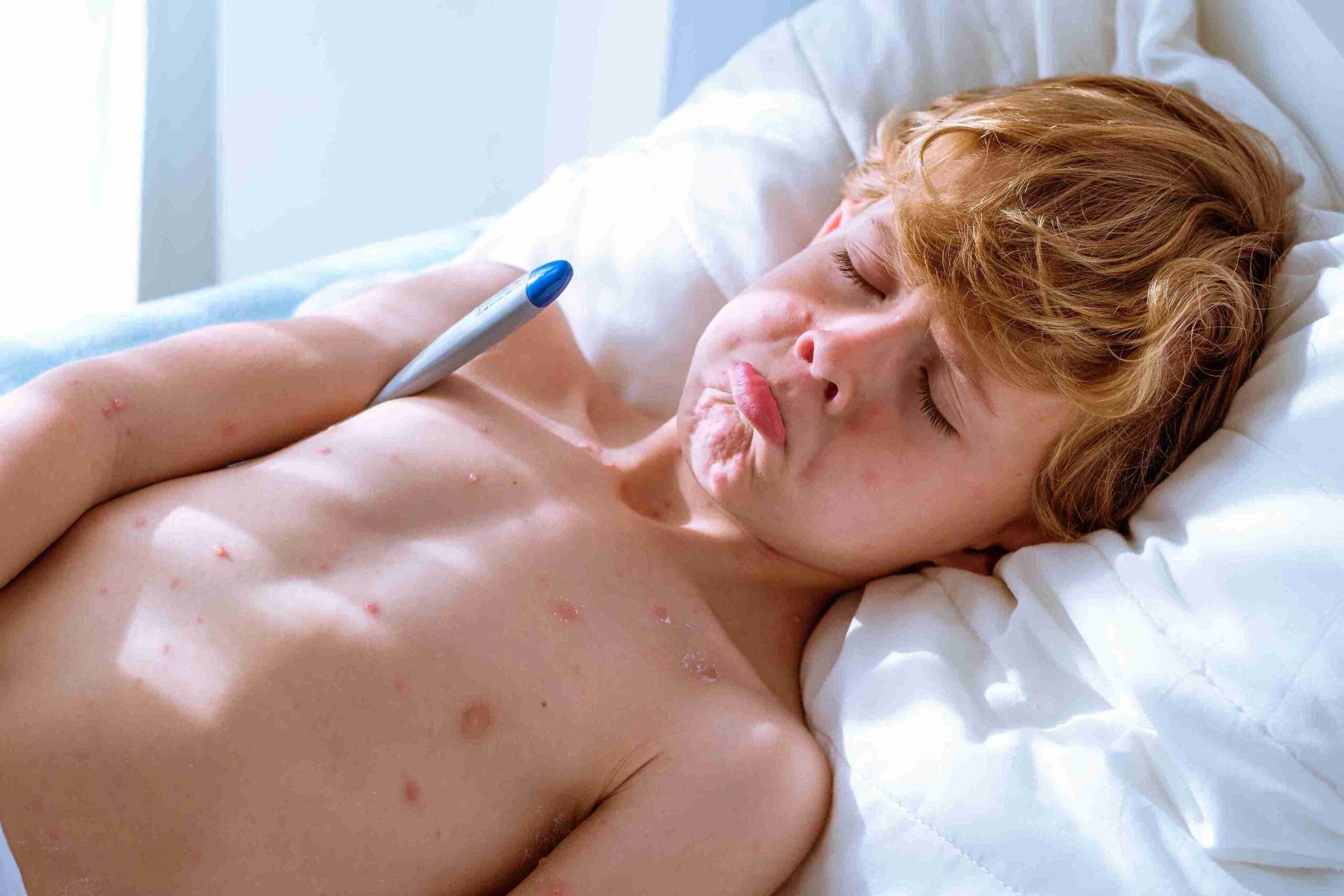 upset-ill-boy-measuring-temperature-2023-11-27-04-52-37-utc_11zon - Allure Wellness child with chicken pox lying in bed